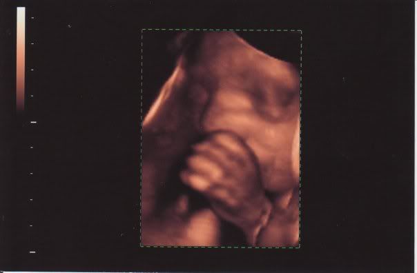 3d ultrasound pictures at 26 weeks. thumb in a 3D ultrasound